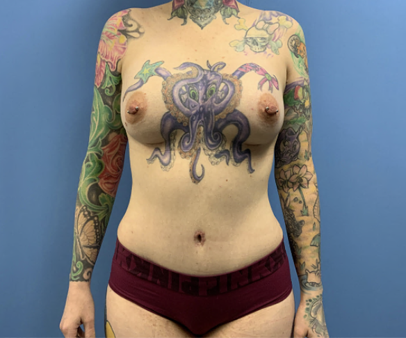 Tummy-Tuck-with-Liposuction--Case-Study-3197 | After Liposuction